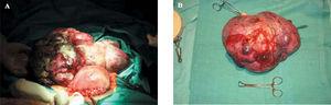 17 cm Tumor dependente do acessório esquerdo. A: Na cama cirúrgica. B: Depois de realizar uma anexetomia de todo o tumor.