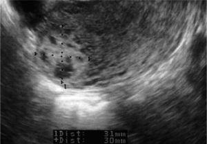 Imatge obtinguda per ecografia transvaginal el dia 8 en la qual es evidència una imatge heterogènia de 31 × 30mm, corresponent a la gestació ectòpica a la banya uterí dret en un tall transversal de l'úter.