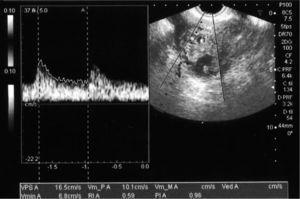 image obtenue par échographie transvaginale le jour 115, dans lequel il est la preuve de la gestation ectopique de 50 × 34 mm dans la corne utérine droite, dans une section transversale de l'utérus, dont les navires présents, dans l'étude Doppler, un indice de résistance de 0,58 et une morphologie de vague typique des artères péritrophoblastiques.