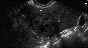 image obtenue par échographie transvaginale le jour 130, en Quelle image de la gestation de 31 × 34 mm est évidente dans la corne utérine droite, dans une section transversale de l'utérus, dans laquelle, en plus d'apprécier une diminution significative de taille, l'étude Doppler n'est plus identifiée d'ondes artérielles. A ce moment-là, la valeur de la gonadotropine chorionique humaine est de 5 MU / ml.