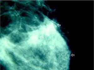 Mamografía magnificada de CSE de MI con múltiples focos de microcalcificaciones sospechosas en ambos cuadrantes superiores (flechas).