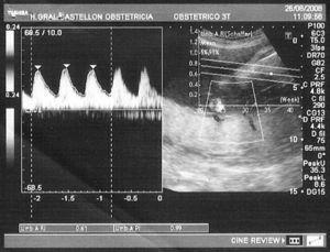 Flujos vasculares (arteria umbilical) normales en estudio ecográfico Doppler. IR 0,61; IP 0,99.