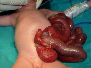 Asas intestinales evisceradas junto con genitales internos y vejiga urinaria.