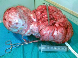 Fibroma ovárico gigante tras extracción quirúgica.