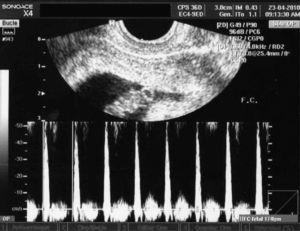Caso 1. Imagen ultrasonográfica con embarazo intrauterino vivo.