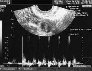 Caso 1. Imagen ultrasonográfica con embarazo extrauterino.