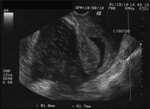 Caso 2. Imagen ultrasonográfica, embarazo intrauterino anembriónico y embarazo extrauterino.
