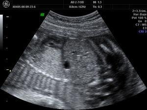 Corte longitudinal del tórax y el abdomen del feto en la semana 26 de gestación donde se observa la masa hiperecogénica pulmonar.