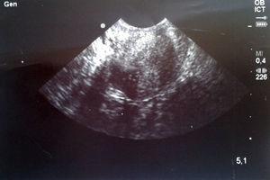 Imagen ecográfica del muñón cervical preoperatorio. Resaltada el área endometrial.