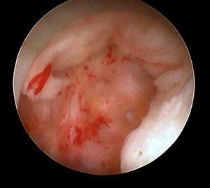 Muñón cervical. Imagen histeroscópica.