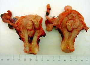 Lesión intrauterina polipoide, que ocluye totalmente la cavidad.