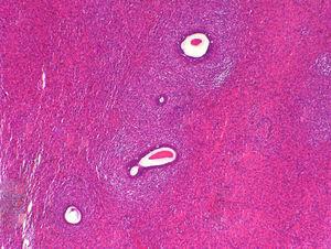 Condensación del estroma alrededor del epitelio glandular benigno («collaretes») (HE×100).