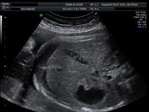 Corte transversal ecográfico mostrando ascitis fetal.
