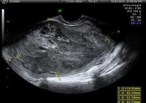Sarcoma uterino con ecografía (bordes no definidos).