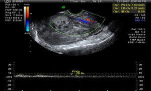Sarcoma uterino en ecografía (abundante vascularización, vasos tortuosos).