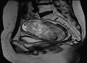 Sarcoma uterino con RM, bordes imprecisos. El sarcoma ocupa «todo» el miometrio.