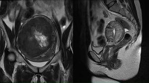 Mioma de 12cm con RM antes y después de la miomectomía por laparoscopia. a) Mioma intramural con abundante vascularización por estudio Doppler color. Antes de la embolización. b) Mioma intramural avascular, después de la embolización de las arterias uterinas.