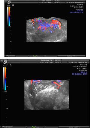 Mioma de 12cm con RM antes y después de la miomectomía por laparoscopia. a) Mioma intramural con abundante vascularización por estudio Doppler color. Antes de la embolización. b) Mioma intramural avascular, después de la embolización de las arterias uterinas.