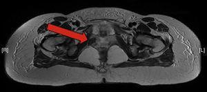 Resonancia magnética que muestra hematoma en canal de Alcock, entre el músculo obturador interno y el elevador del ano, de 22×34×19mm, que produce la neuropatía secundaria del nervio pudendo.