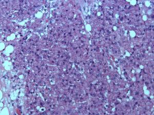 Similar imagen a la anterior, aunque a menor aumento. Se trata de un tumor compuesto por células grandes con núcleo central pequeño y uniforme con citoplasma eosinófilo.