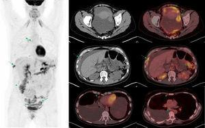 Estadificación pretratamiento de cáncer de ovario. Paciente de 48 años con diagnóstico por TC de carcinomatosis peritoneal de origen ovárico o carcinoma primario peritoneal. Se realiza PET-TC de estadificación previamente al tratamiento. La imagen de cuerpo entero de PET (izquierda) muestra captación aumentada de FDG en una masa ovárica izquierda (flecha) e implantes peritoneales (asterisco) pelvianos (derecha, arriba) y en colon ascendente (centro). En la región torácica, se visualizan implantes pleurales derechos (centro; flecha discontinua) y en adenopatías cardiofrénicas y mediastínicas (derecha, abajo; punta de flecha), que contraindican la cirugía citorreductora como tratamiento primario.