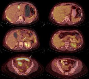 Valoración de respuesta al tratamiento en cáncer de ovario. Paciente de 38 años diagnosticada de carcinoma serosopapilar de ovario. Se realizó PET-TC basal (izquierda) y tras 3 ciclos de tratamiento de quimioterapia para valoración de respuesta (derecha). Las imágenes de fusión PET-TC muestran desaparición de los implantes peritoneales perihepáticos (arriba), pelvianos (abajo) y normalización del metabolismo en una adenopatía paraórtica izquierda (centro).