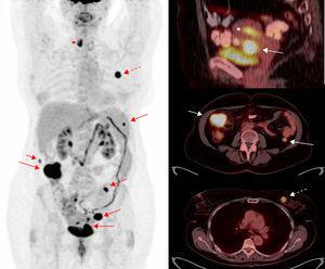 Estadificación pretratamiento de cáncer de endometrio. Paciente de 65 años con carcinoma endometrial de células claras remitida para valoración pretratamiento. Imagen de cuerpo entero de PET (izquierda) e imágenes de fusión PET-TC (derecha) en proyección sagital (arriba) y axial (centro y abajo). Muestran la tumoración primaria en el cuerpo uterino (asterisco) con implantes peritoneales (flechas) y una neoplasia primaria en cuadrantes internos de la mama izquierda (flecha discontinua). Bocio multinodular en lóbulo tiroideo derecho (estrella).