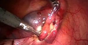 Imagen laparoscópica: salpingectomía derecha.