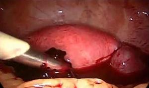 Imagen laparoscópica: evacuación de hemoperitoneo.