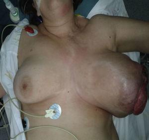 Aspecto macroscópico de la mama antes de la intervención.