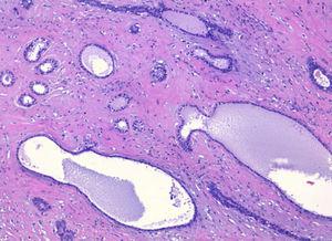 Fibroadenoma con patrón de crecimiento pericanalicular y un incremento leve a moderado de la celularidad estromal (×10).
