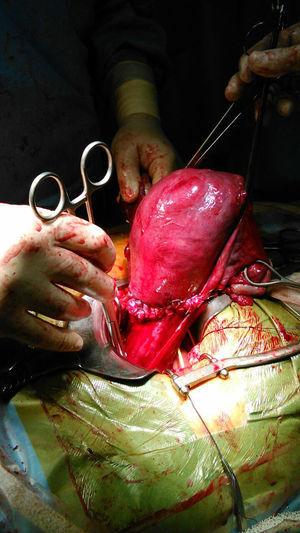 Útero de la paciente tras la realización de la cesárea, histerorrafia transversa.