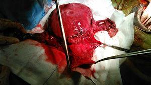 Pieza quirúrgica tras la histerectomía radical.