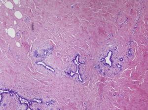 Lesión con márgenes de crecimiento infiltrativos, fusocelular, que atrapa adipocitos maduros (HE ×40).