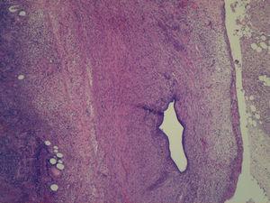 Detalle de proliferación de tejido endometrial en la capa serosa del apéndice cecal (hematoxilina-eosina, x100).