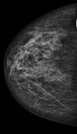 Mamografía de mama derecha.