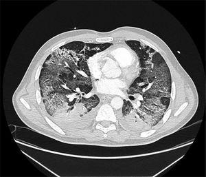 Tomografía axial computarizada (TAC) pulmonar de paciente con COVID grave. Destacan los extensos infiltrados bilaterales en vidrio deslustrado con engrosamiento de los septos interlobulillares.