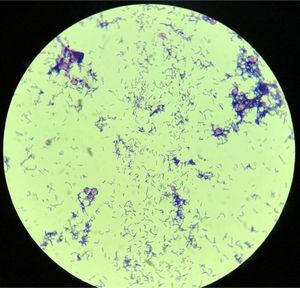 Gram stain of Arcanobacterium haemolyticum colony showing irregularly shaped gram-positive rods recovered from blood culture. Microscopic magnification: 1000×.