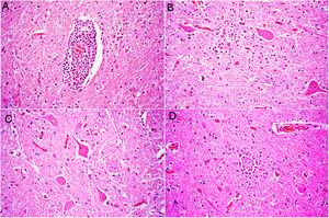 Lesiones histológicas en la vaca con encefalitis por astrovirus bovino neurotrópico; coloración de hematoxilina y eosina, ×400. A)Infiltración de linfocitos, macrófagos y células plasmáticas en un espacio perivenular en la corteza cerebral. B)Gliosis e infiltración de linfocitos en el neurópilo del tronco encefálico. C)Una neurona (centro de la imagen) en el tronco encefálico presenta hipereosinofilia citoplasmática y núcleo picnótico (necrosis neuronal). D)Una neurona necrótica en la corteza cerebral se encuentra rodeada de células gliales e inflamatorias (satelitosis) e invadida por dichas células (neuronofagia).