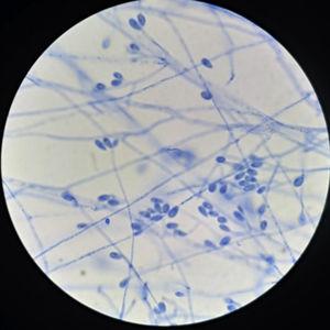 Lactophenol cotton blue stain of Scedosporium aurantiacum. Conidiogenous cells, producing ovoid-shaped conidia, either individually or in small groups.