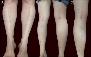 (A) Patient with red-brown patches and petechiae symmetrically distributed on the lower extremities. (B and C) Lesions on the posterior aspect of the left leg in a linear disposition, with blaschkoid distribution.