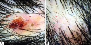 (A) Hematic crust (blue arrow) and erythematous-yellowish area (red arrow). (B) Yellow dots (blue arrow), short regrowing hairs (red arrow), and interfollicular erythema (green arrow). Trichoscopy performed with 3Gen DermLite® II Hybrid M with polarized light and with interface liquid (alcohol 70%); ×20 magnification.
