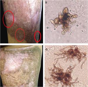 Six months of therapy with itraconazole. (A) Plaque border with fine scaling, and black dots. (B) Sclerotic cells with emission of short filaments or “Borelli spiders”. One year after treatment with itraconazole. (C) Scaling on the superior border of the plaque. (D) Sclerotic cells with emission of long filaments or “Borelli spiders”.