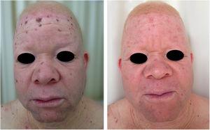 Treatment of actinic damage. Albino patient with multiple actinic keratoses and solar lentigines treated with cryotherapy.