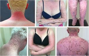 Actinic damage in albinism. Albino patients presenting actinic damage in photoexposed areas.