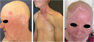 Sequelae of skin cancer. Albino patients with multiple scars and mutilations due to previous surgeries for excision of skin cancers.