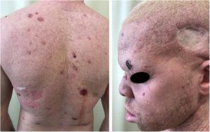 Morbimortality associated with skin cancer. Young albino patient with multiple tumors (BCC and SCC) and surgical scars from previous excisions.