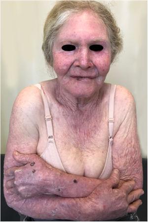 Cumulative solar damage – unprotected exposure. Elderly albino patient with multiple actinic damage in photoexposed areas. History of basal cell carcinoma and squamous cell carcinoma.