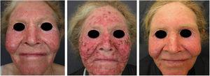 Treatment of the cancerization field. Albino patient with multiple actinic keratoses on the face. The image shows the result of treatment of the cancerization field with 5-fluorouracil.