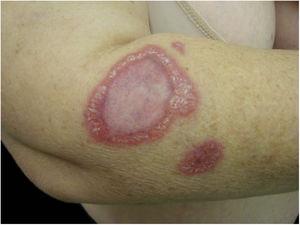 Annular granuloma presented by a 52-year-old woman. B. henselae DNA was amplified in a fragment of the mediastinal lymph node and in the patient's blood.